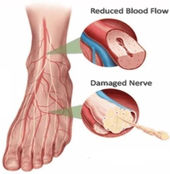 Neuropathies | Best Neurology specialist in Hyderabad | Dr. Soumya Reddy | Canes Cardio & Neuro Clinic Kondapur