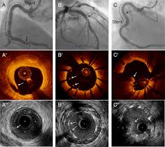 OCT / IVUS Guided Stenting | Best Cardiology specialist in Hyderabad | Dr. Kiran Kumar Lakki Reddy | Canes Cardio & Neuro Clinic Kondapur