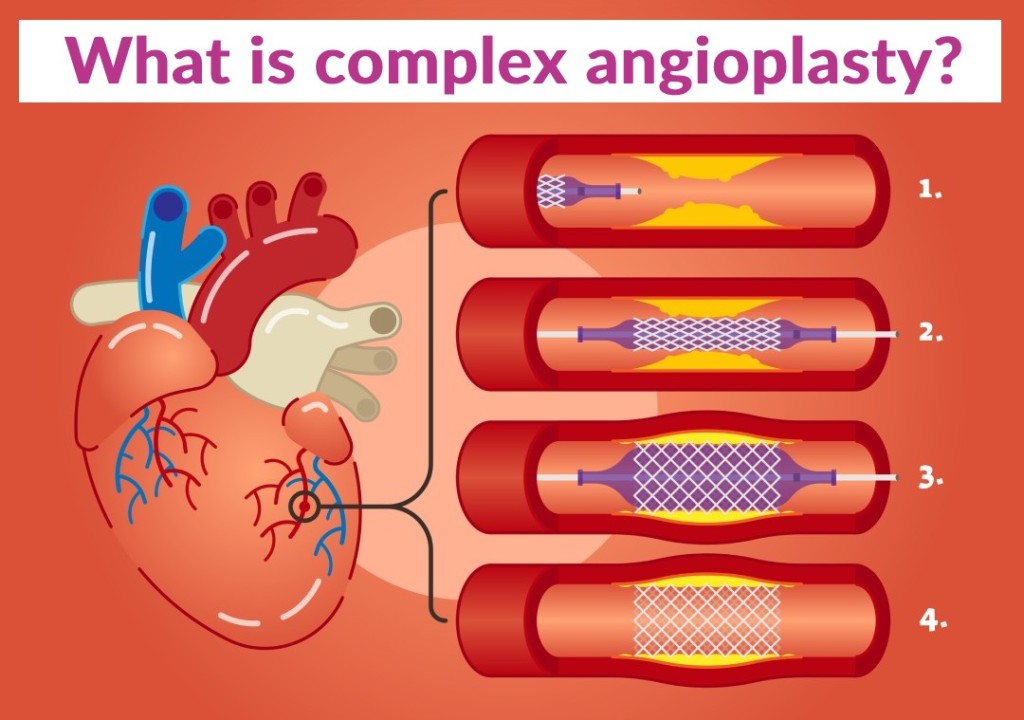 Complex Coronary Angioplasty (Stenting) in Hyderabad - Dr Kiran Lakkireddy Cardiologist in Hyderabad - CANES Clinic