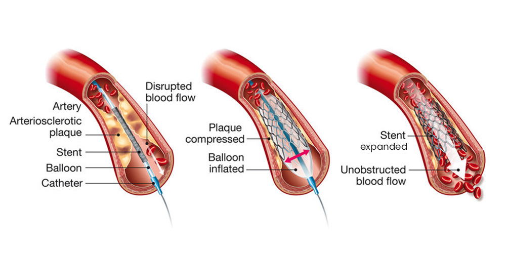 Coronary Angioplasty (Stenting) in Hyderabad - Dr Kiran Lakkireddy Cardiologist Hyderabad - CANES Clinic