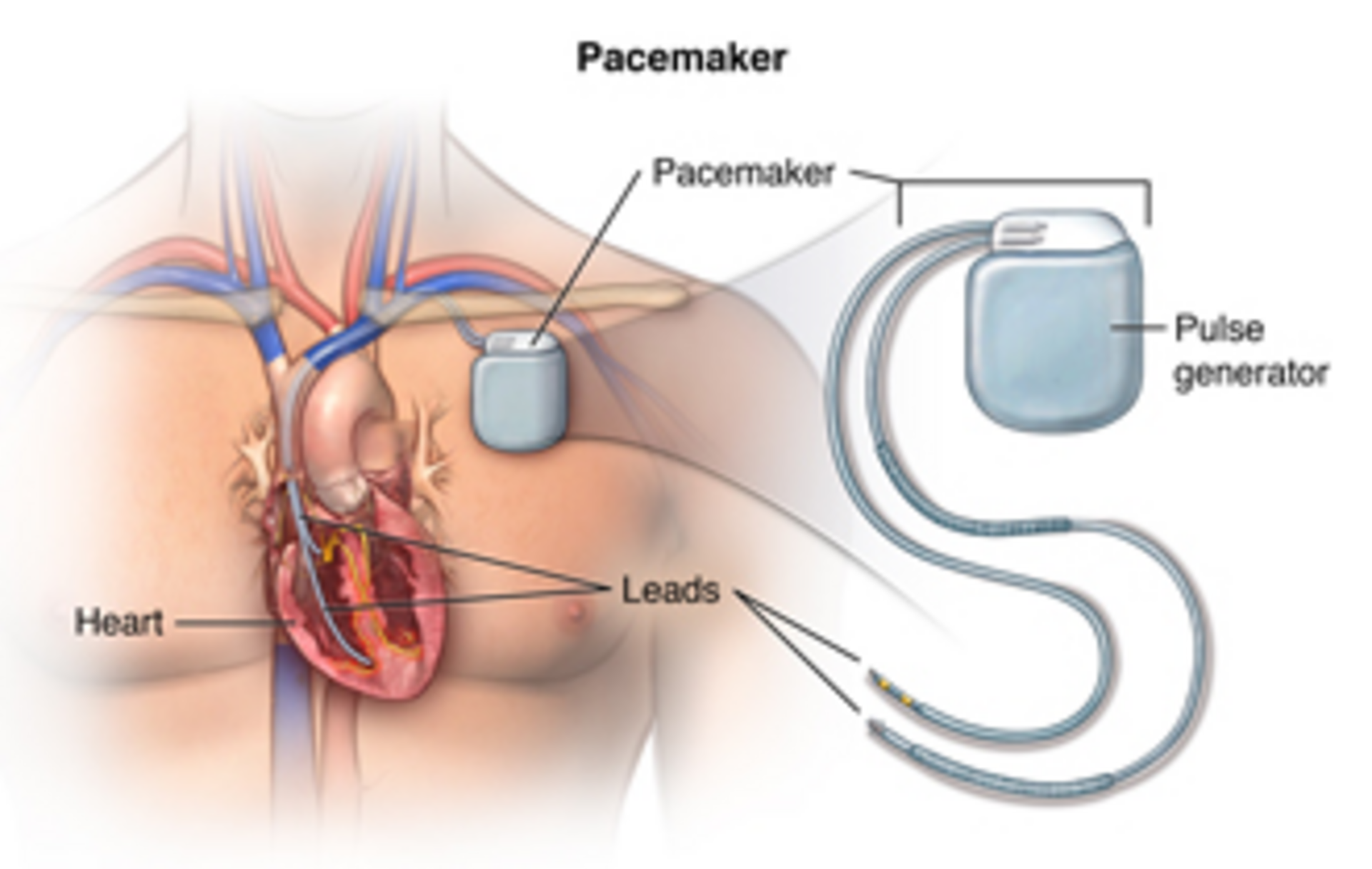 Pacemaker / ICD / CRT Implantation in Kondapur -Dr Kiran Lakkireddy Cardiologist - CANES Clinic