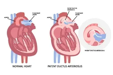 Paediatric Cardiac Interventions in Kondapur - Dr Kiran Lakkireddy Cardiologist - CANES Clinic
