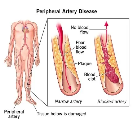 Peripheral Artery Intervention in Konapur - Dr Kiran Lakkireddy Cardiologist - CANES Clinic