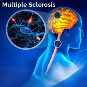 Multiple Sclerosis Treatment in Kondapur - Dr Soumya Neurologist - CANES Clinic