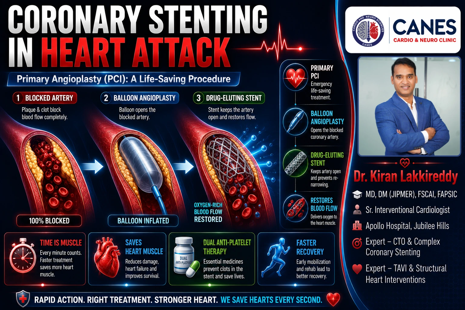 Crucial Guide: Coronary Stenting in Heart Attack & Recovery
